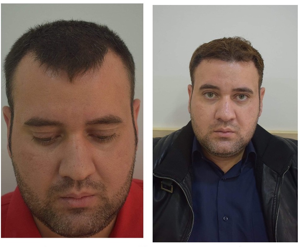 Hair Transplant Before After