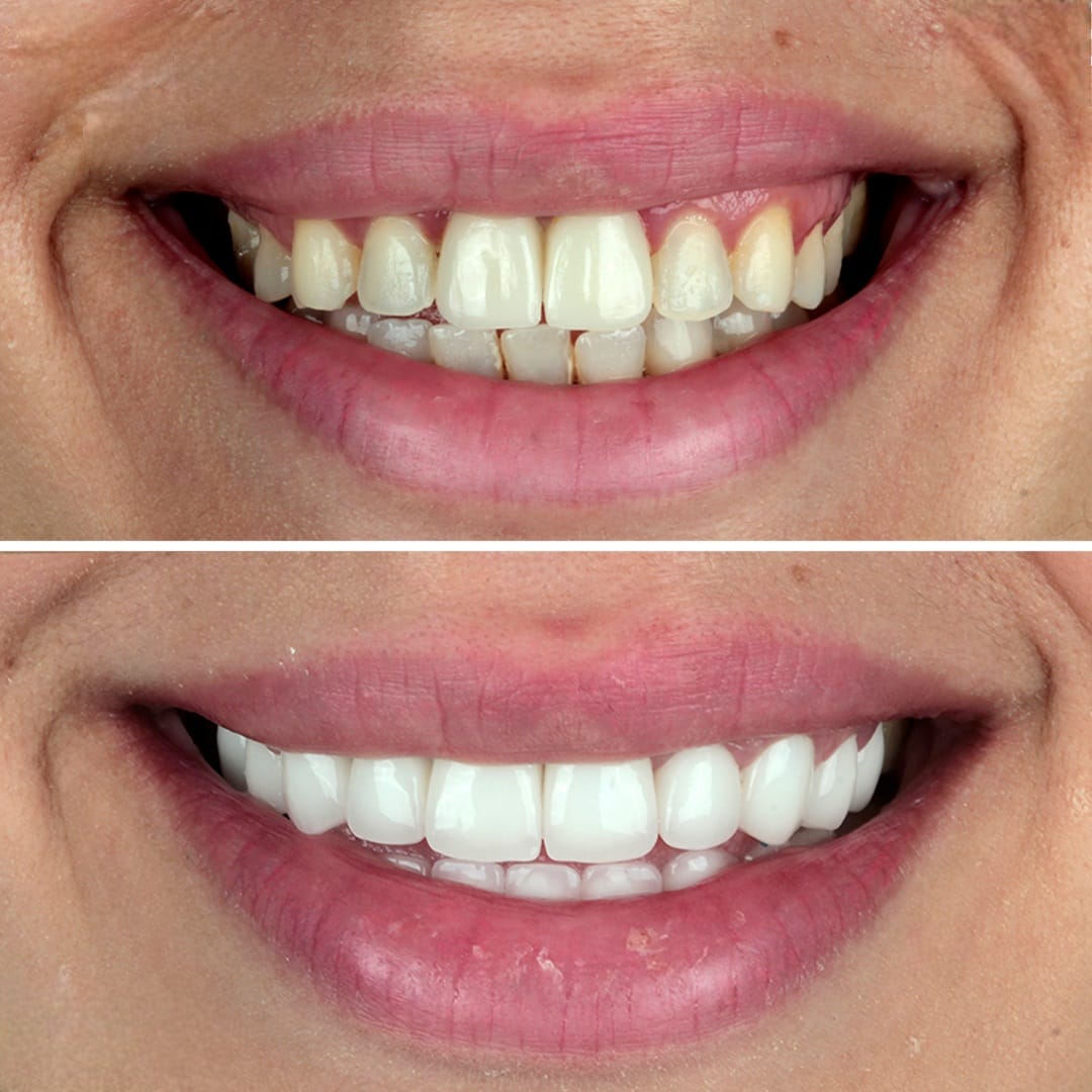 Dental Before After