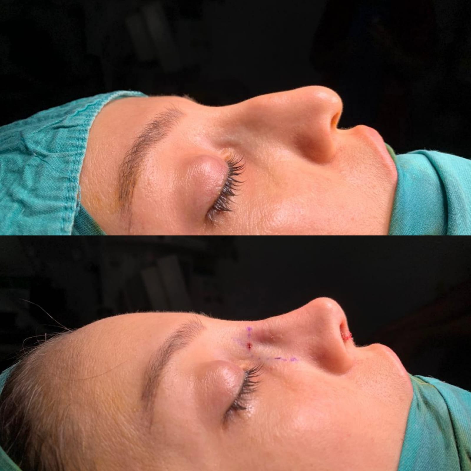 Rhinoplasty & Nose Job Before After